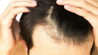 man touching his hairline