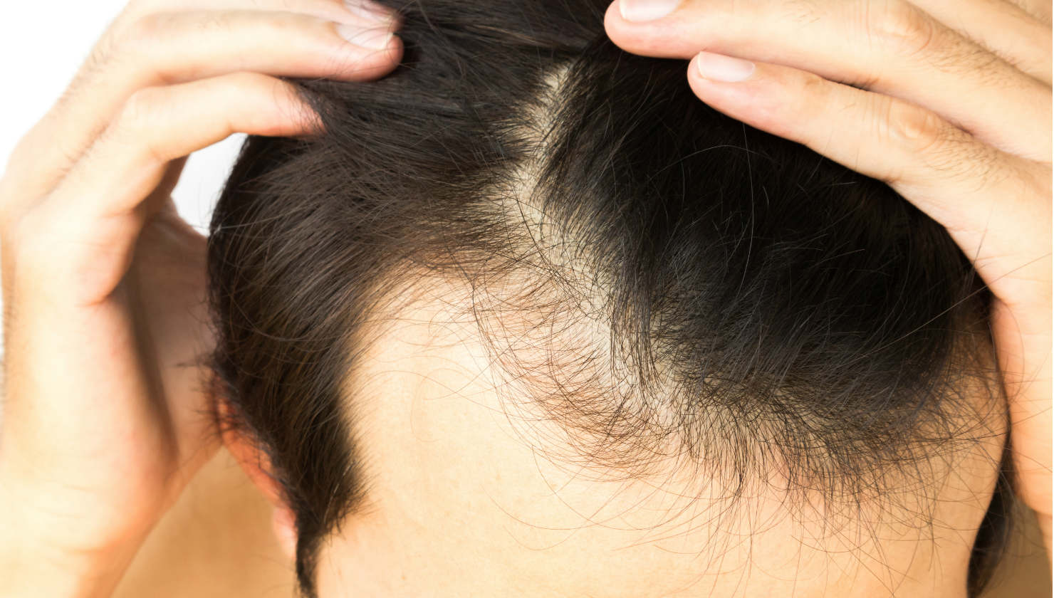 Αραίωση Μαλλιών: 5 Facts που Πρέπει να Ξέρετε! man touching his hairline