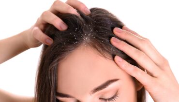 dandruff